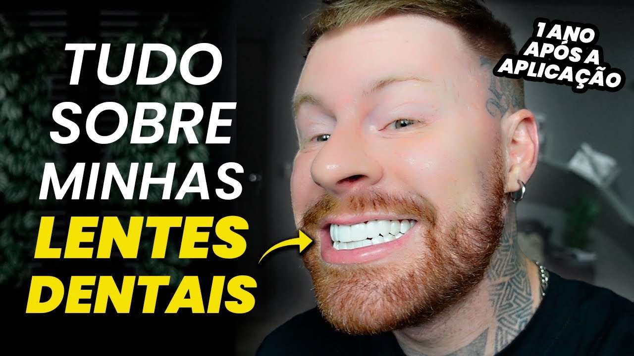 LENTES DE CONTATO DENTAIS: 1 ANO pós COLOCAÇÃO (Me Arrependi? Como é o Cuidado? Quanto Custou?)