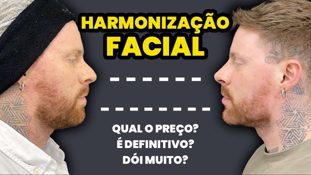 HARMONIZAÇÃO FACIAL MASCULINA: Antes e Depois - Respondendo Dúvidas sobre o Procedimento